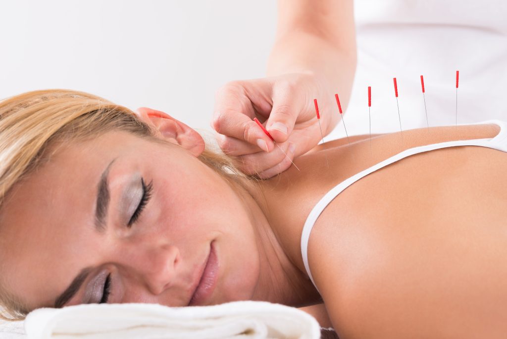 acupuncture for pain relief